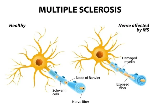 Top-notch Multiple Sclerosis Specialists North Brisbane Australia