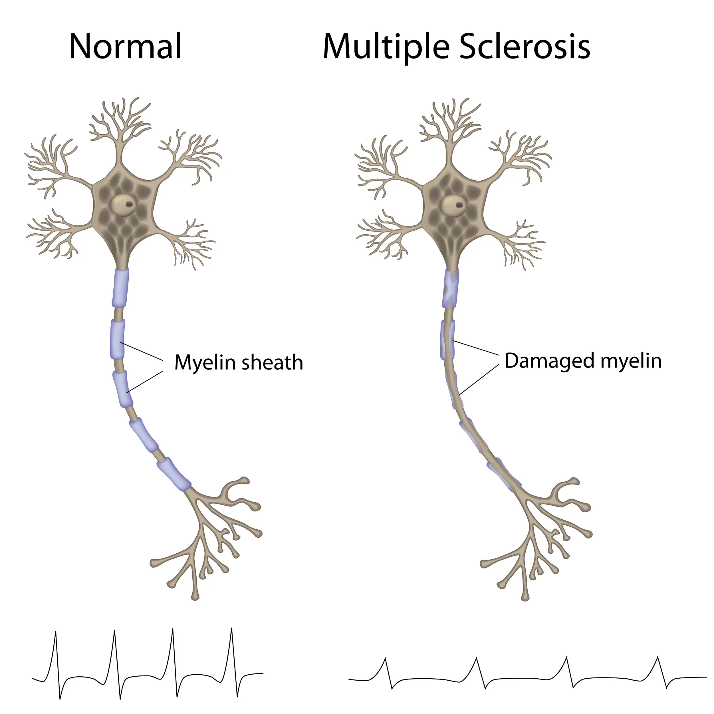 Best Multiple Sclerosis Specialists North Brisbane Australia