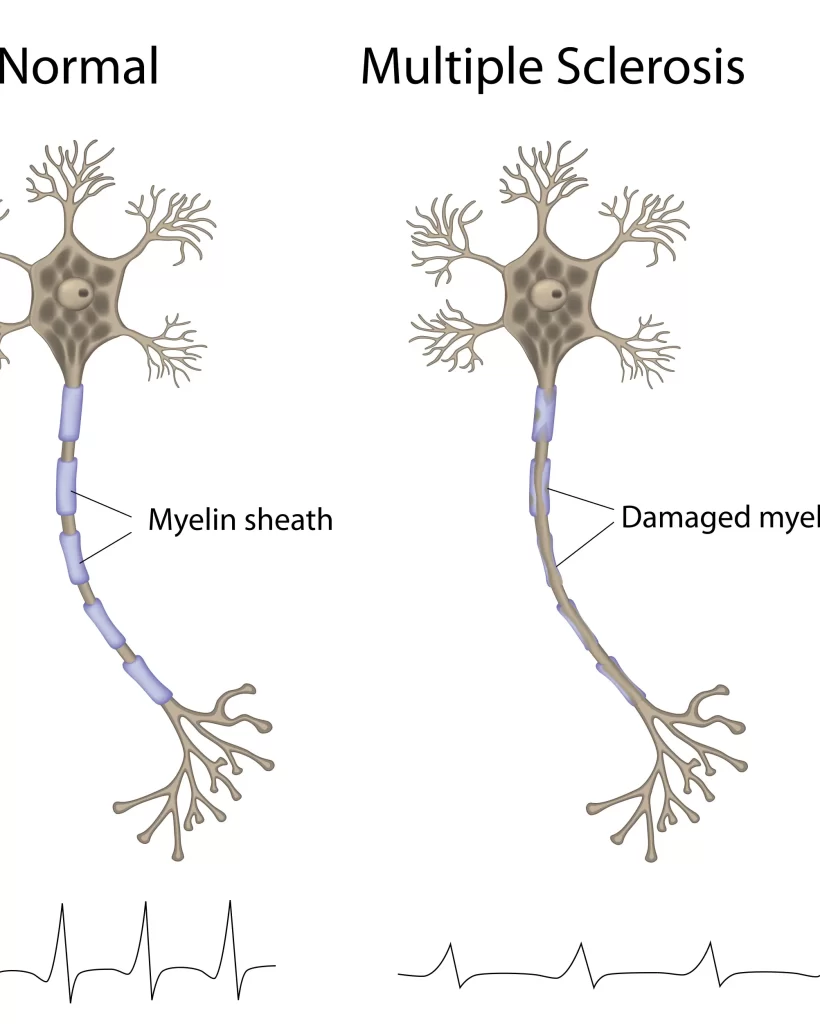 Best Multiple Sclerosis Specialists North Brisbane Australia